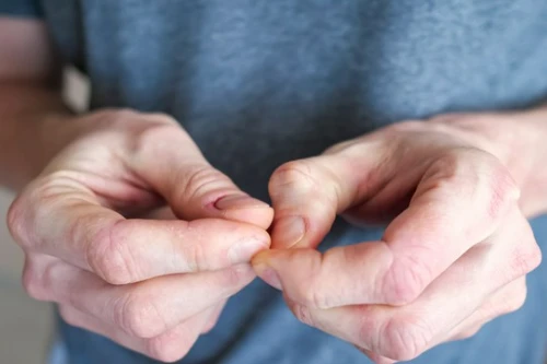 mężczyzna zrywa skórki przy paznokciach u rąk